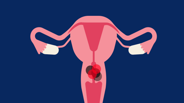 Sundhedsøkonom: Det er overkill og spild af penge at vaccinere og screene kvinder for livmoderhalskræft