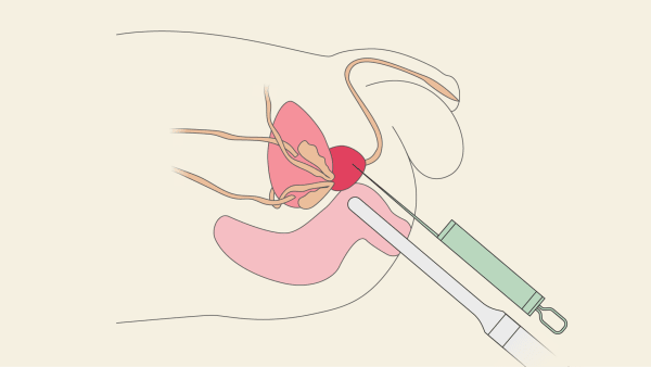 Ny metode har halveret indlæggelser efter biopsi for prostatakræft