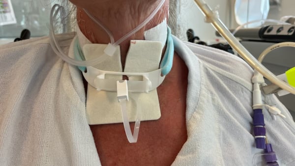 Ny opfindelse: Hjælp kan være på vej til respiratorpatienter verden over